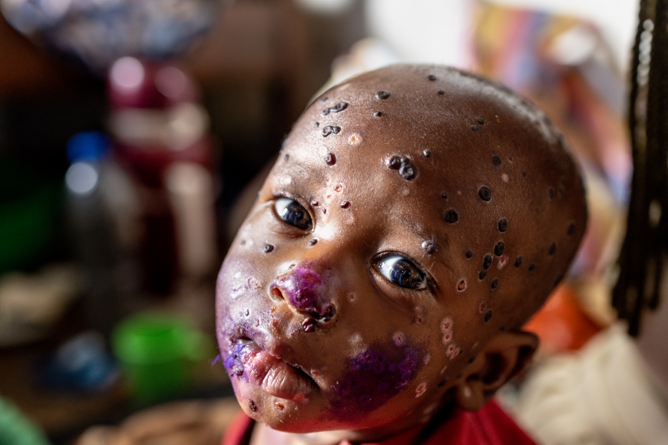 Child with monkeypox blisters on his face